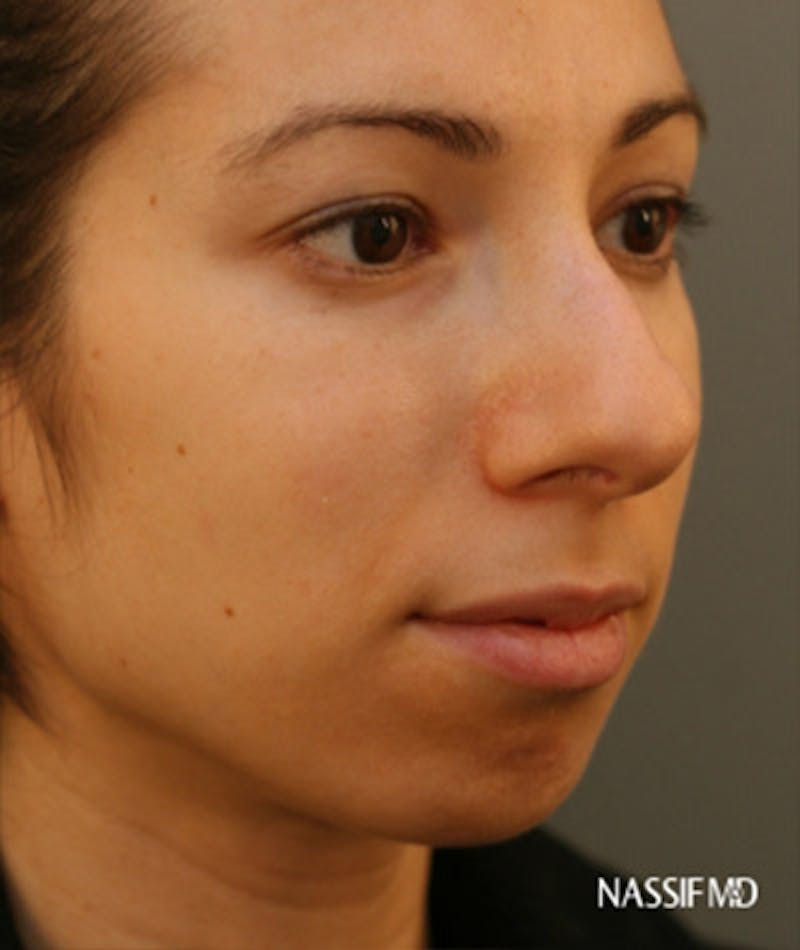 Ethnic Rhinoplasty Before & After Gallery - Patient 108174692 - Image 5