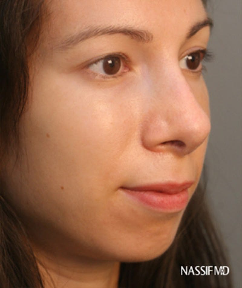 Ethnic Rhinoplasty Before & After Gallery - Patient 108174692 - Image 6