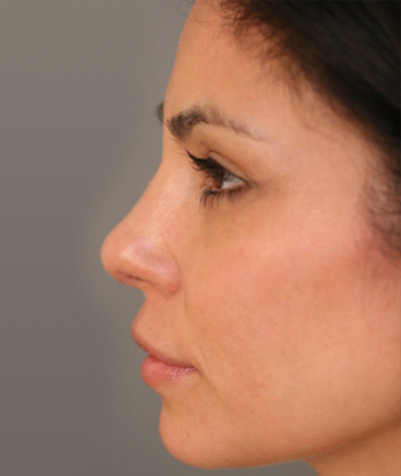 Ethnic Rhinoplasty Before & After Gallery - Patient 108179566 - Image 2