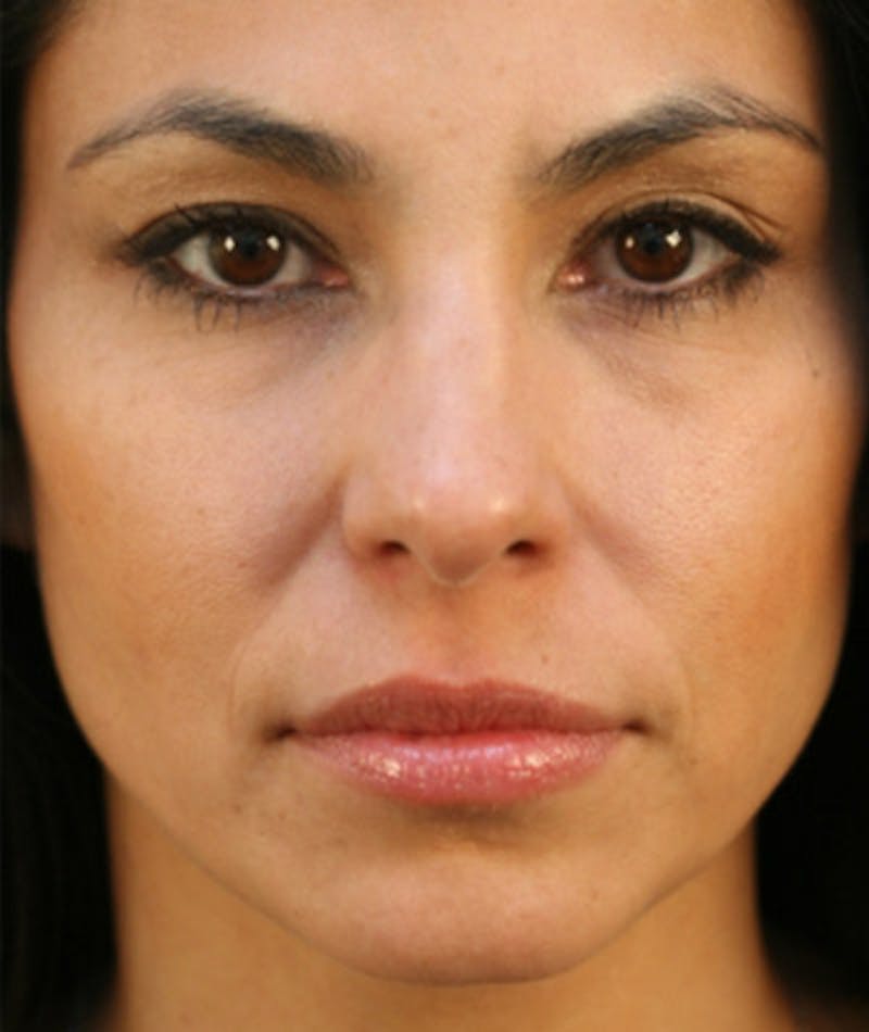 Ethnic Rhinoplasty Before & After Gallery - Patient 108179566 - Image 3