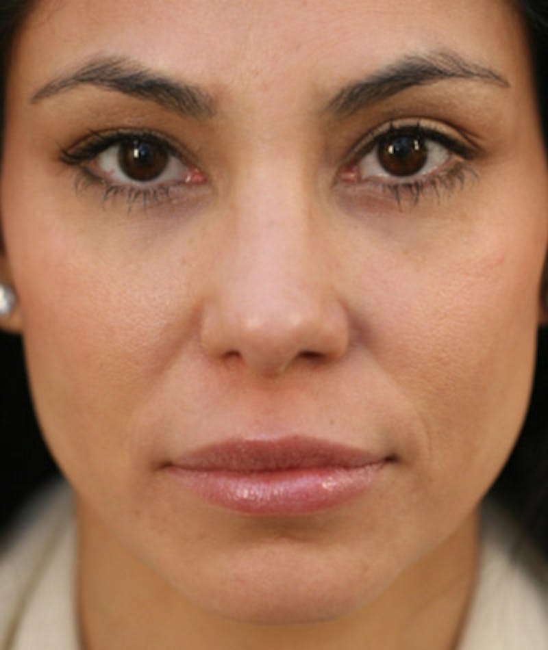 Ethnic Rhinoplasty Before & After Gallery - Patient 108179566 - Image 4