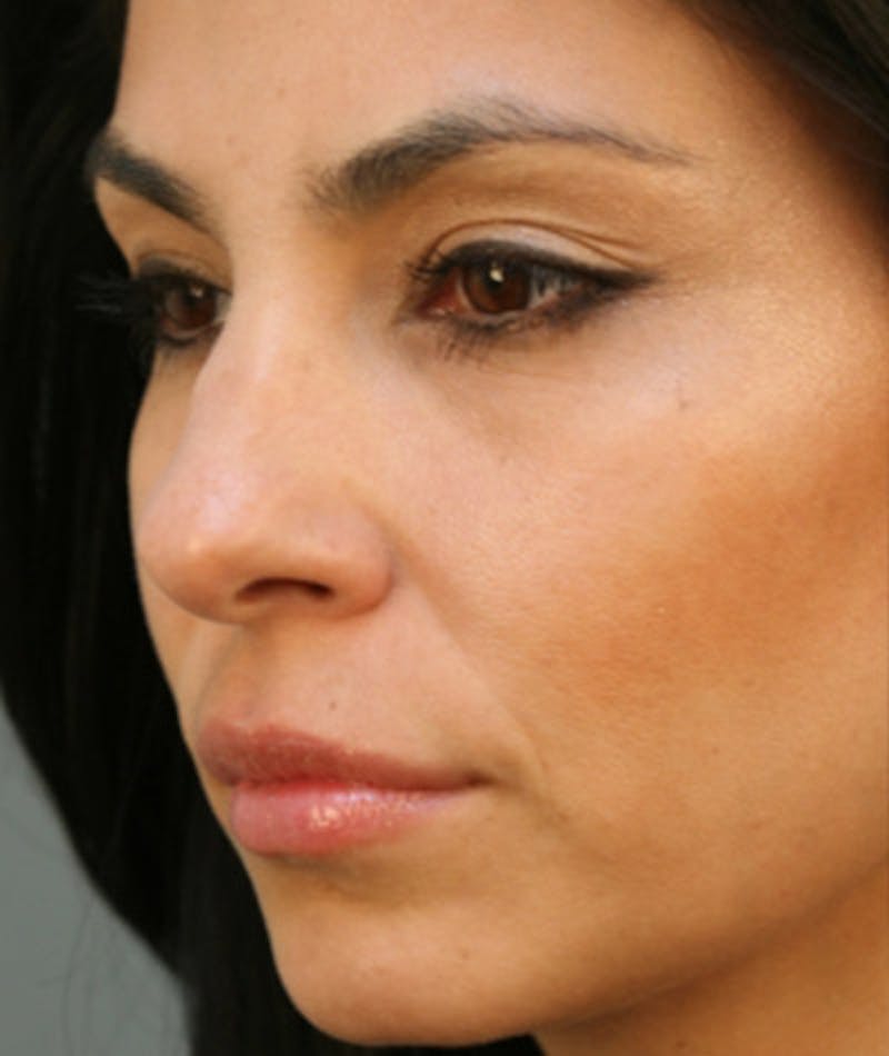 Ethnic Rhinoplasty Before & After Gallery - Patient 108179566 - Image 5