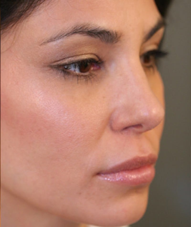 Ethnic Rhinoplasty Before & After Gallery - Patient 108179566 - Image 8