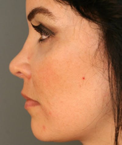 Ethnic Rhinoplasty Before & After Gallery - Patient 108179576 - Image 2
