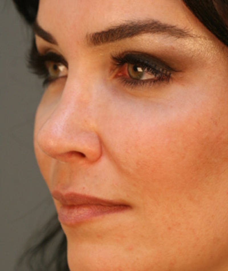 Ethnic Rhinoplasty Before & After Gallery - Patient 108179576 - Image 8