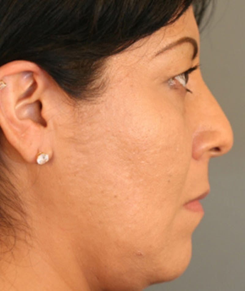 Ethnic Rhinoplasty Before & After Gallery - Patient 108179600 - Image 1