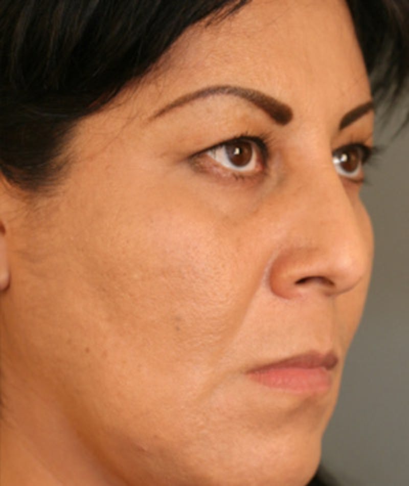 Ethnic Rhinoplasty Before & After Gallery - Patient 108179600 - Image 5