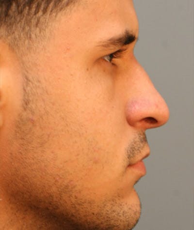 Ethnic Rhinoplasty Before & After Gallery - Patient 108179605 - Image 1