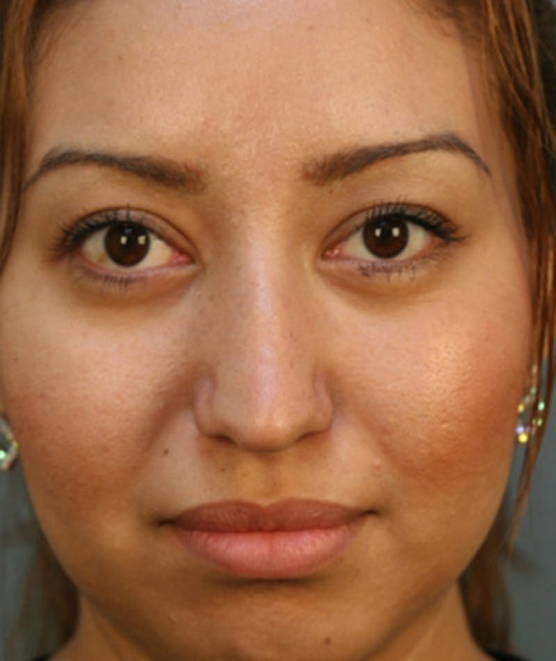 Ethnic Rhinoplasty Before & After Gallery - Patient 108179607 - Image 3