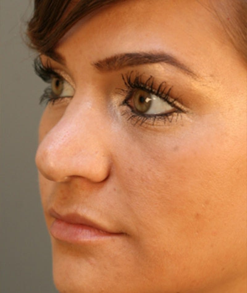 Ethnic Rhinoplasty Before & After Gallery - Patient 108179609 - Image 5