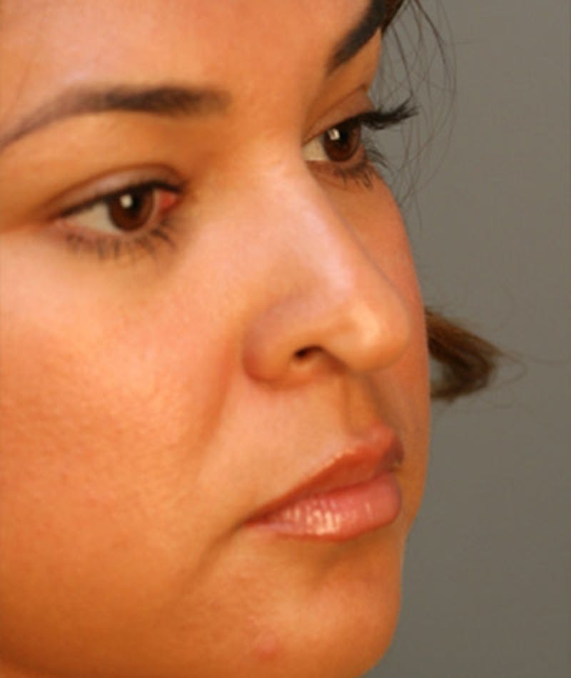 Ethnic Rhinoplasty Before & After Gallery - Patient 108179610 - Image 3