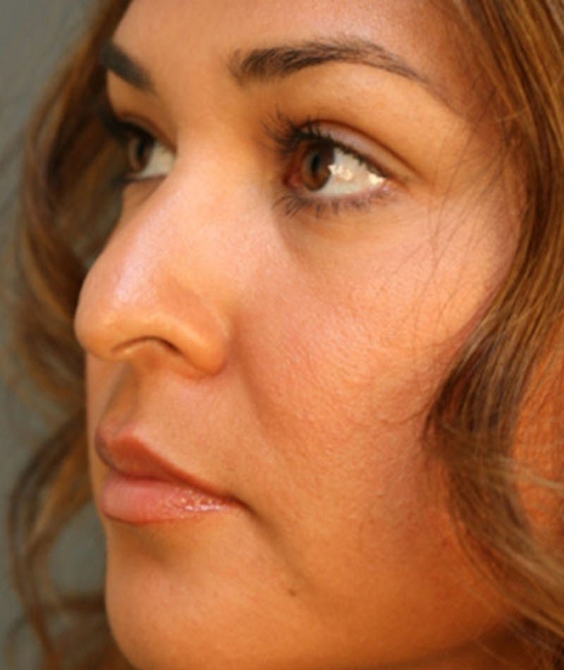 Ethnic Rhinoplasty Before & After Gallery - Patient 108179610 - Image 5