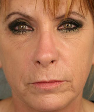 Ethnic Rhinoplasty Before & After Gallery - Patient 108179611 - Image 4