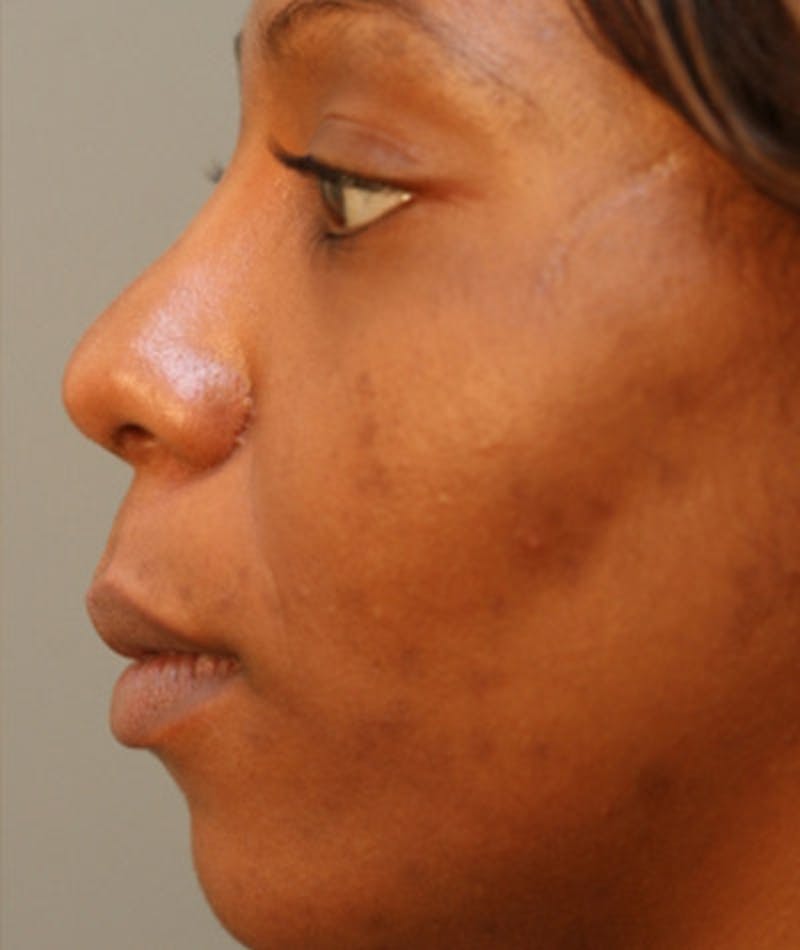 Ethnic Rhinoplasty Before & After Gallery - Patient 108179612 - Image 2