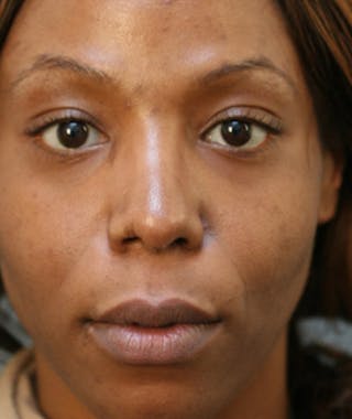 Ethnic Rhinoplasty Before & After Gallery - Patient 108179612 - Image 4