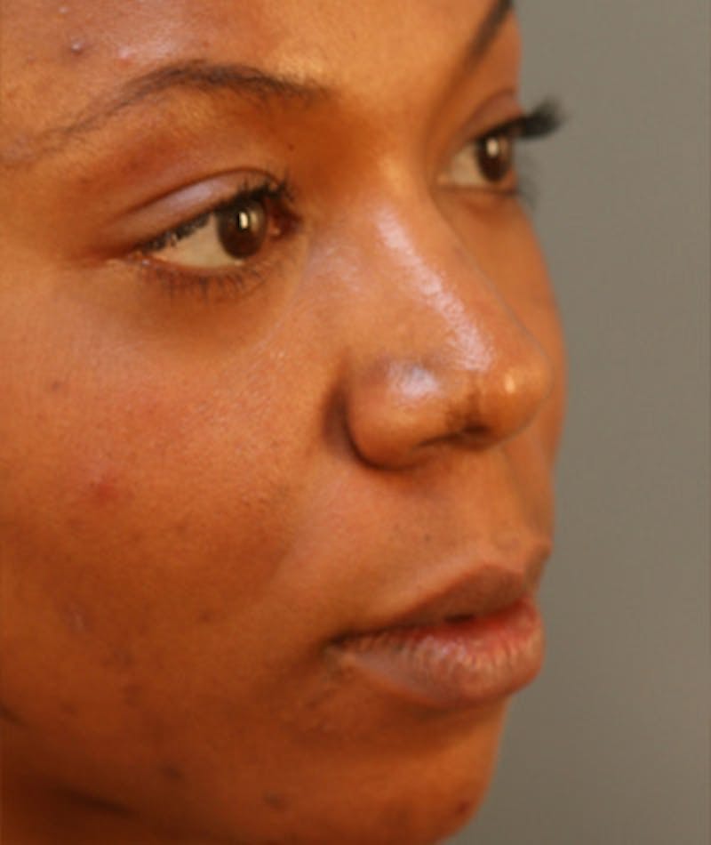 Ethnic Rhinoplasty Before & After Gallery - Patient 108179612 - Image 5