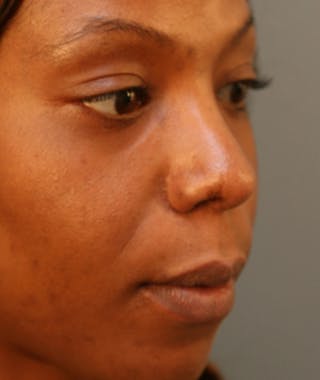 Ethnic Rhinoplasty Before & After Gallery - Patient 108179612 - Image 6