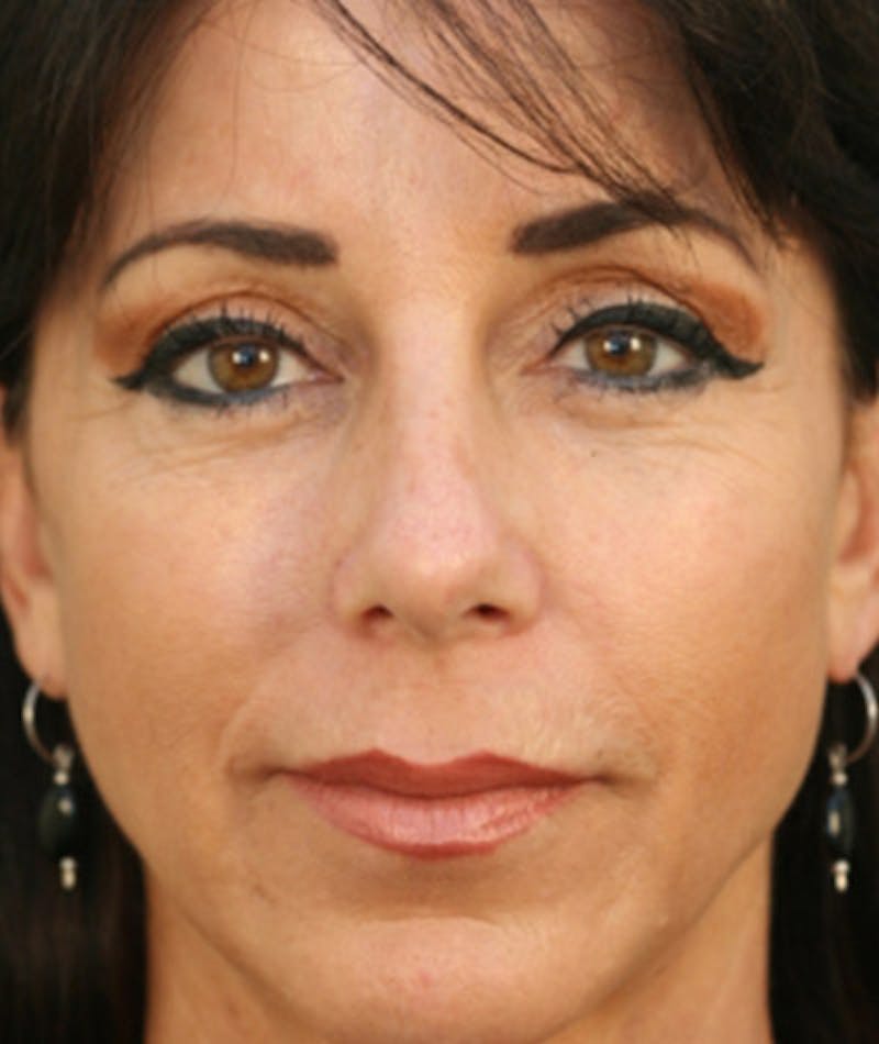 Ethnic Rhinoplasty Before & After Gallery - Patient 108179613 - Image 4