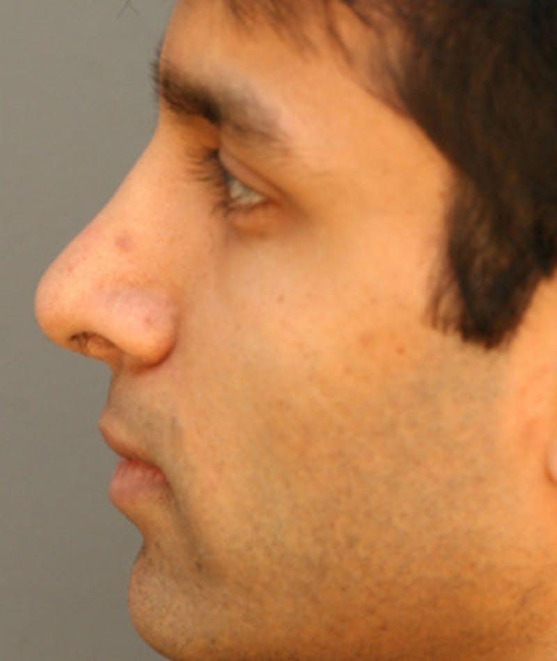Ethnic Rhinoplasty Before & After Gallery - Patient 108179639 - Image 2