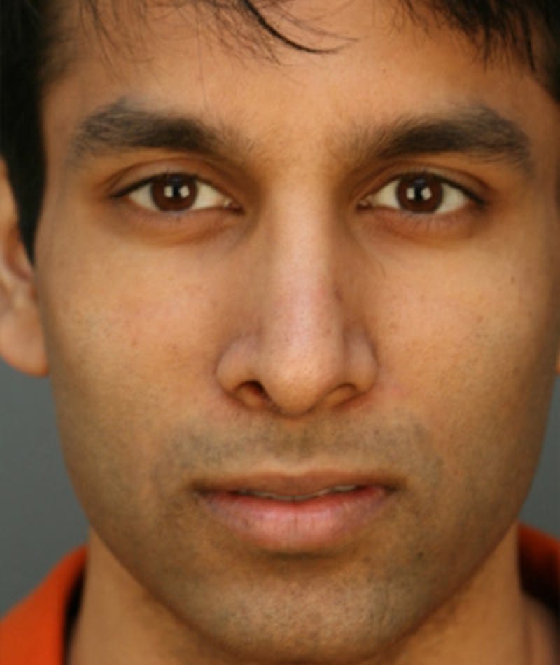 Ethnic Rhinoplasty Before & After Gallery - Patient 108179639 - Image 4