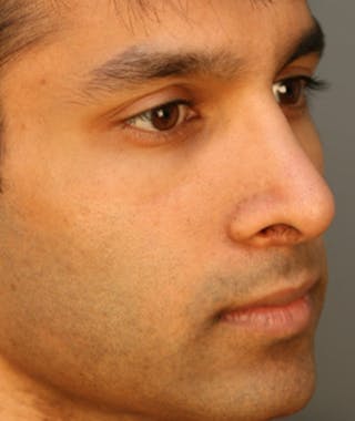 Ethnic Rhinoplasty Before & After Gallery - Patient 108179639 - Image 6