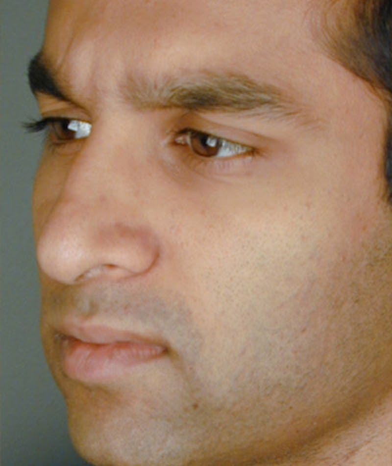 Ethnic Rhinoplasty Before & After Gallery - Patient 108179639 - Image 7