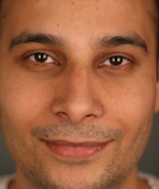 Ethnic Rhinoplasty Before & After Gallery - Patient 108189801 - Image 4