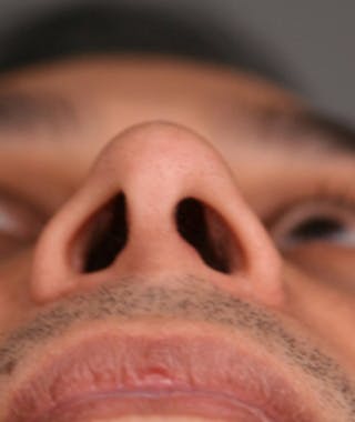 Ethnic Rhinoplasty Before & After Gallery - Patient 108189801 - Image 8