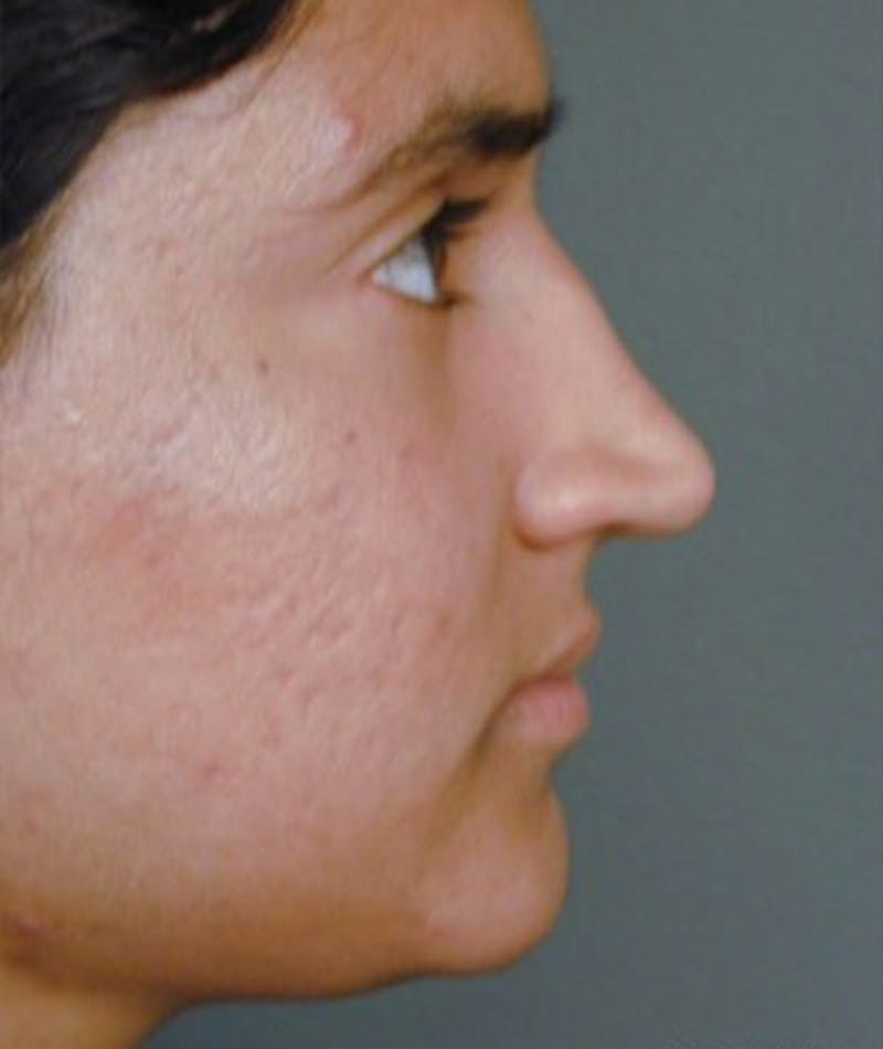 Ethnic Rhinoplasty Before & After Gallery - Patient 108189804 - Image 1