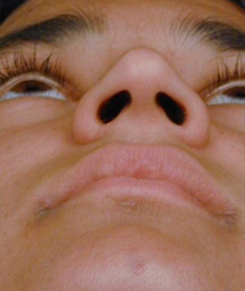 Ethnic Rhinoplasty Before & After Gallery - Patient 108189804 - Image 3