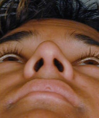 Ethnic Rhinoplasty Before & After Gallery - Patient 108189804 - Image 4