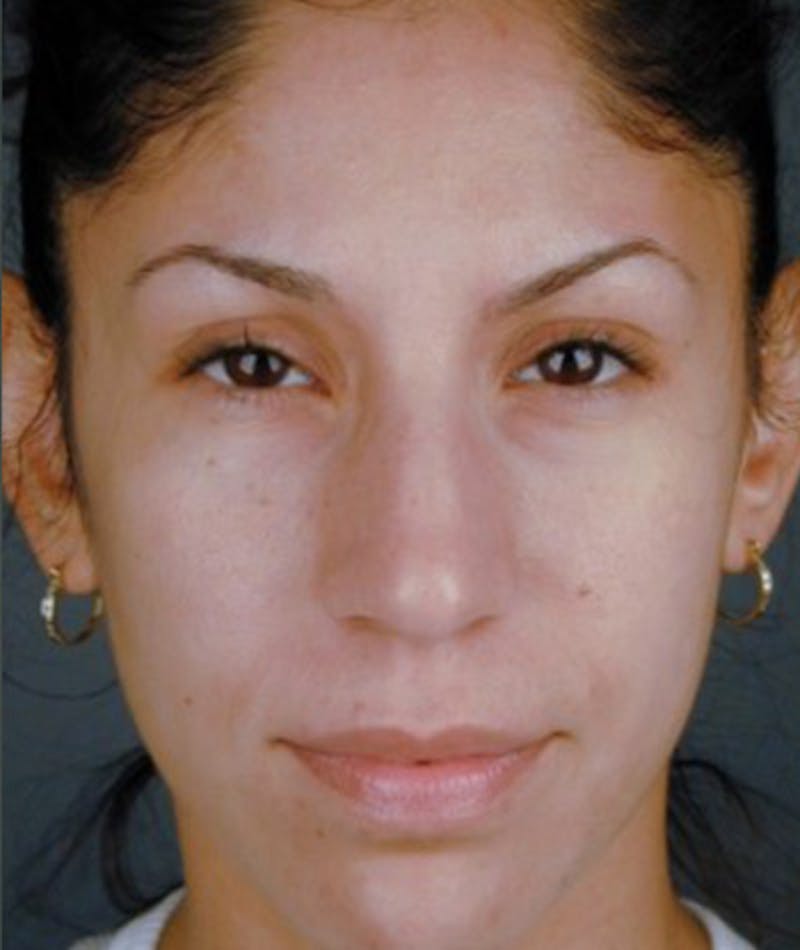 Ethnic Rhinoplasty Before & After Gallery - Patient 108189805 - Image 3