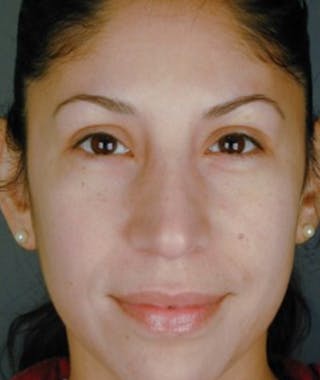 Ethnic Rhinoplasty Before & After Gallery - Patient 108189805 - Image 4