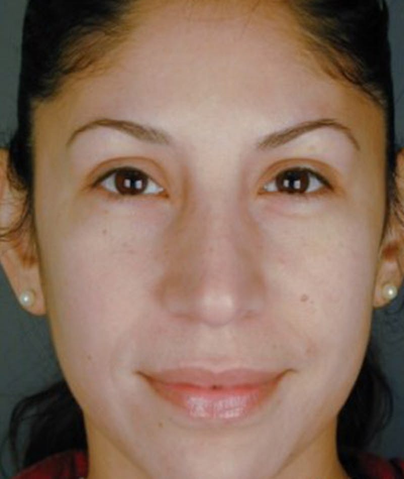 Ethnic Rhinoplasty Before & After Gallery - Patient 108189805 - Image 4