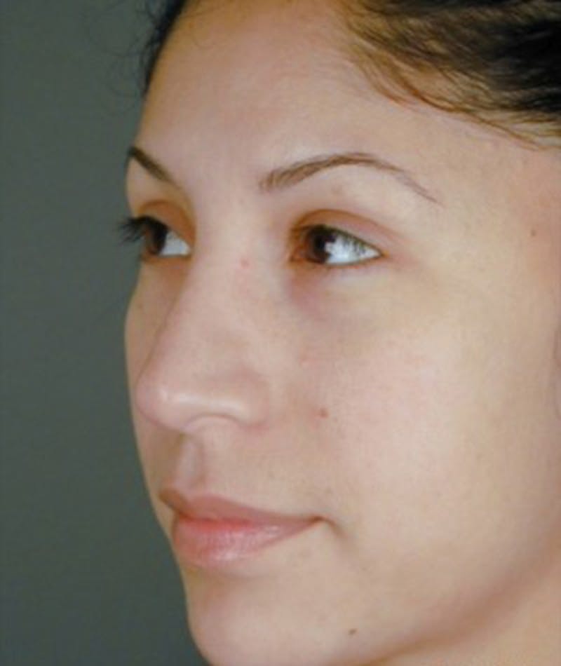 Ethnic Rhinoplasty Before & After Gallery - Patient 108189805 - Image 6