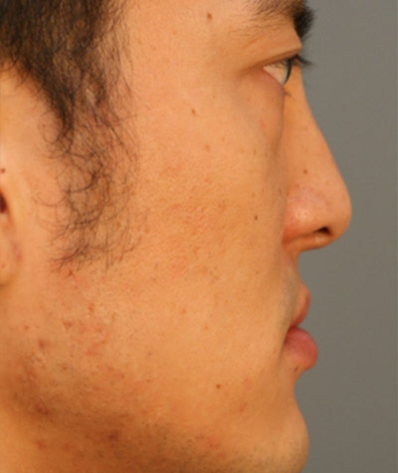 Ethnic Rhinoplasty Before & After Gallery - Patient 108189857 - Image 1