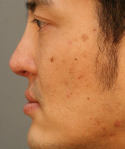 Ethnic Rhinoplasty Before & After Gallery - Patient 108189857 - Image 2