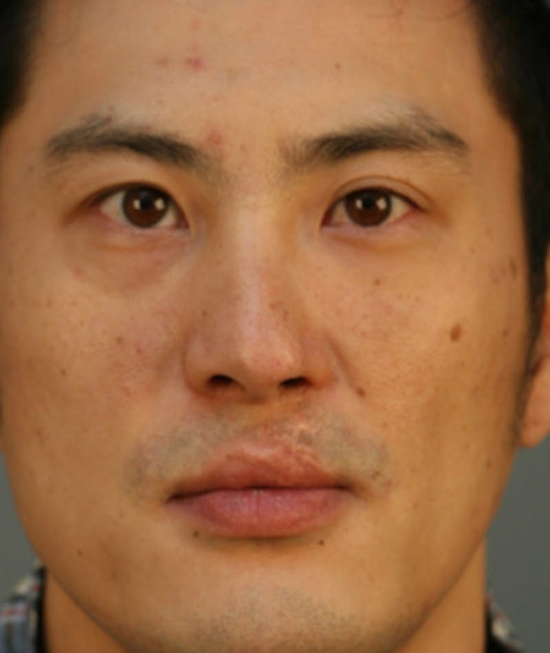 Ethnic Rhinoplasty Before & After Gallery - Patient 108189857 - Image 3