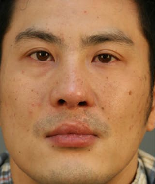 Ethnic Rhinoplasty Before & After Gallery - Patient 108189857 - Image 4