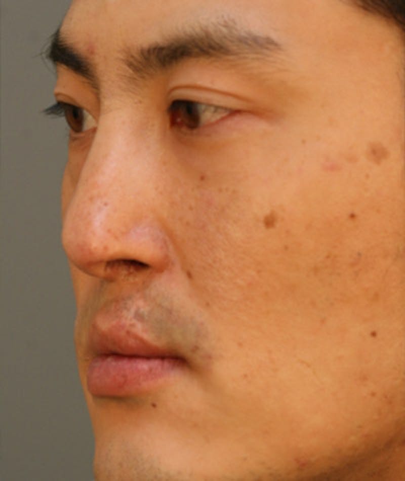 Ethnic Rhinoplasty Before & After Gallery - Patient 108189857 - Image 5