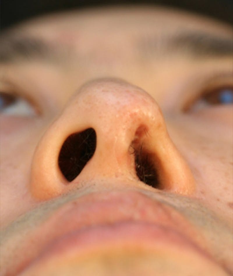 Ethnic Rhinoplasty Before & After Gallery - Patient 108189857 - Image 7