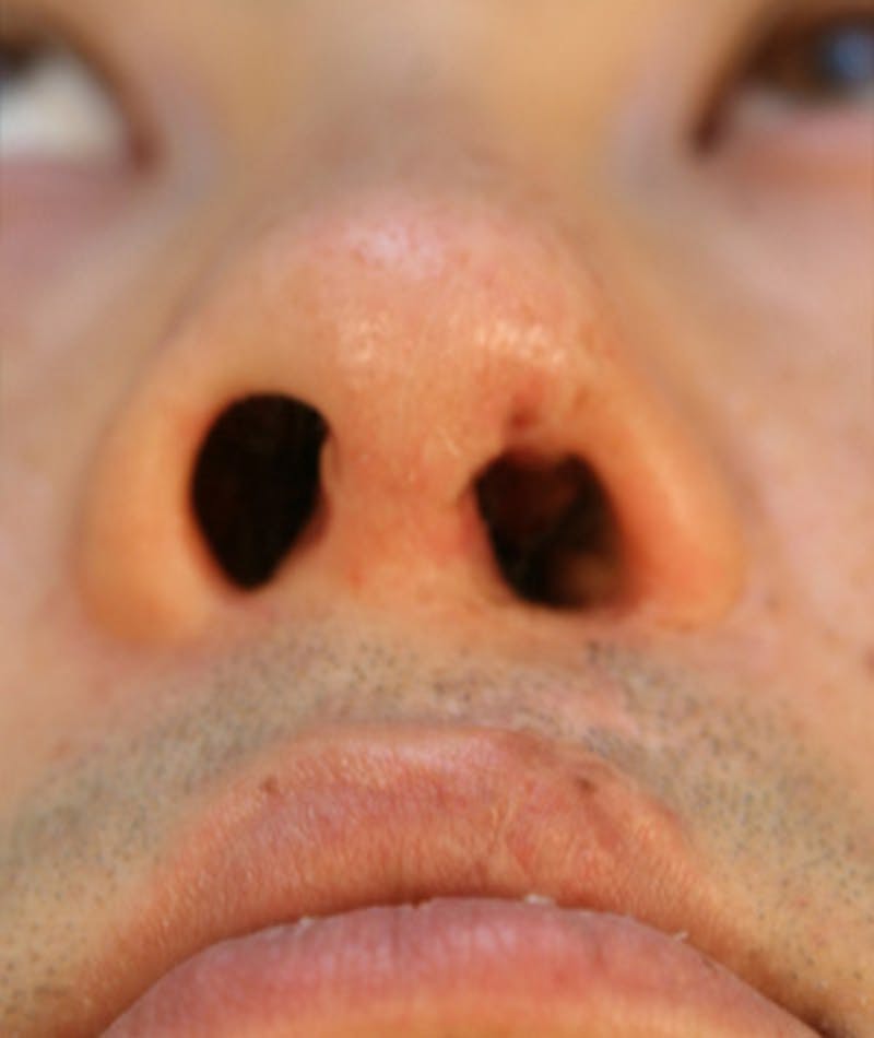Ethnic Rhinoplasty Before & After Gallery - Patient 108189857 - Image 8