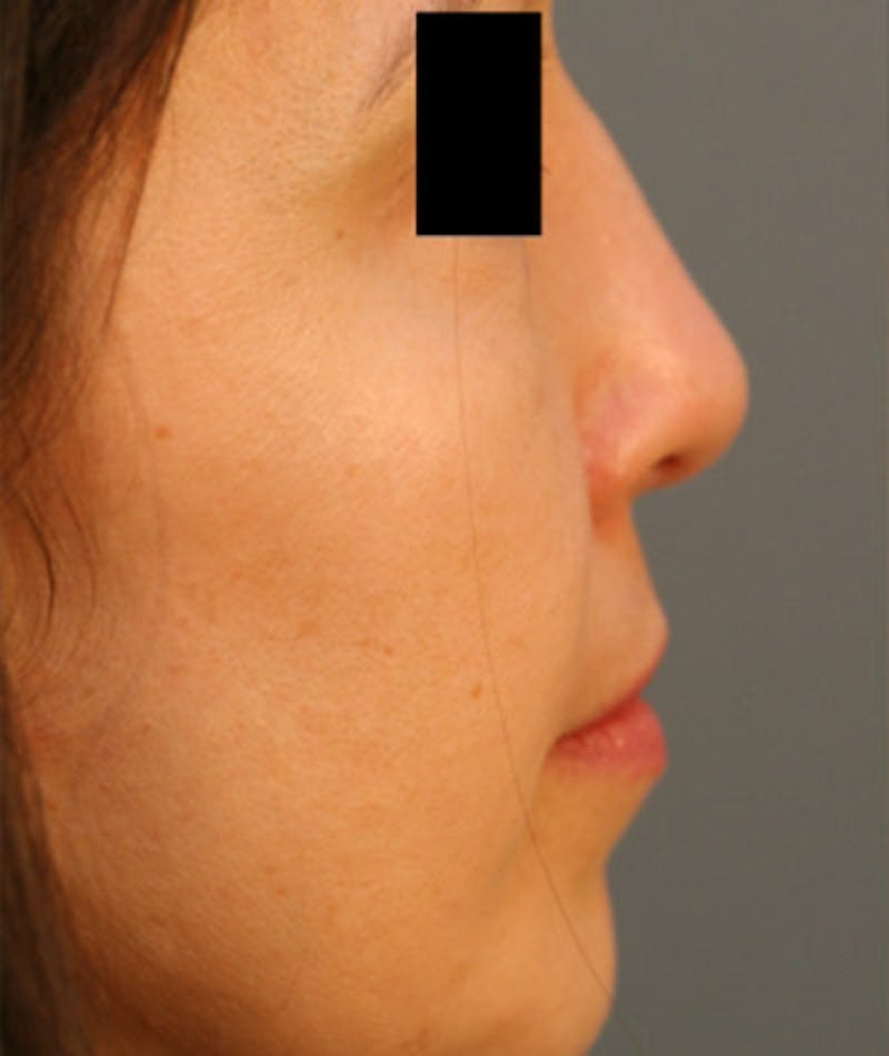 Ethnic Rhinoplasty Before & After Gallery - Patient 108189859 - Image 1