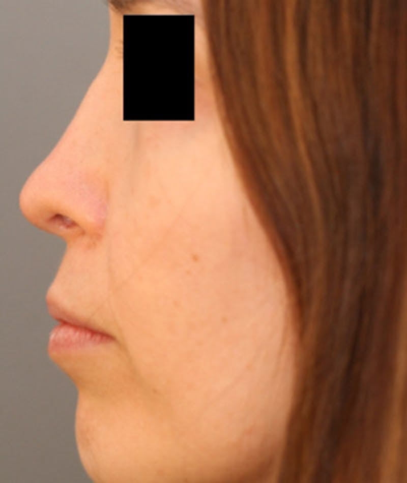 Ethnic Rhinoplasty Before & After Gallery - Patient 108189859 - Image 2