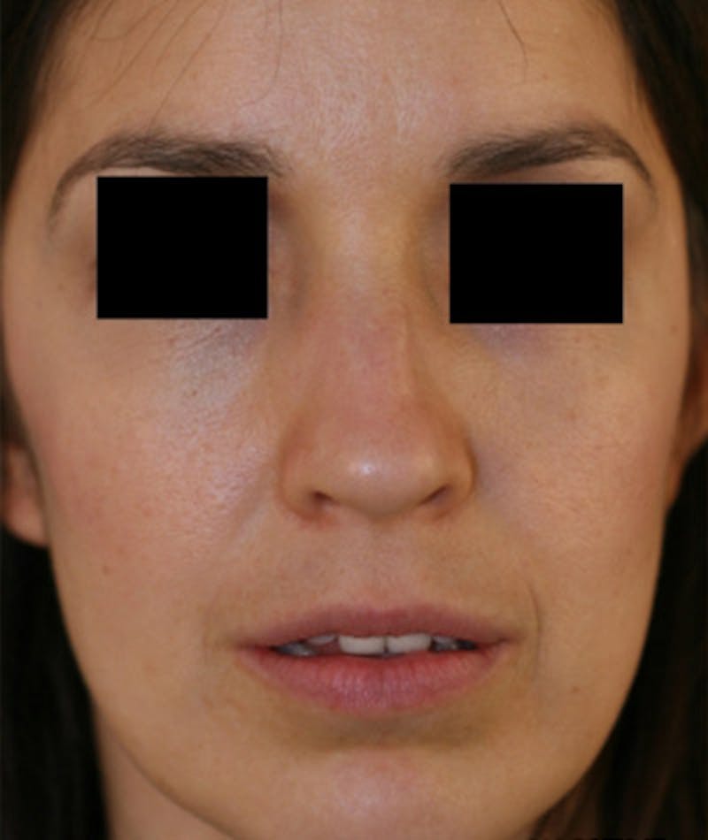 Ethnic Rhinoplasty Before & After Gallery - Patient 108189859 - Image 3