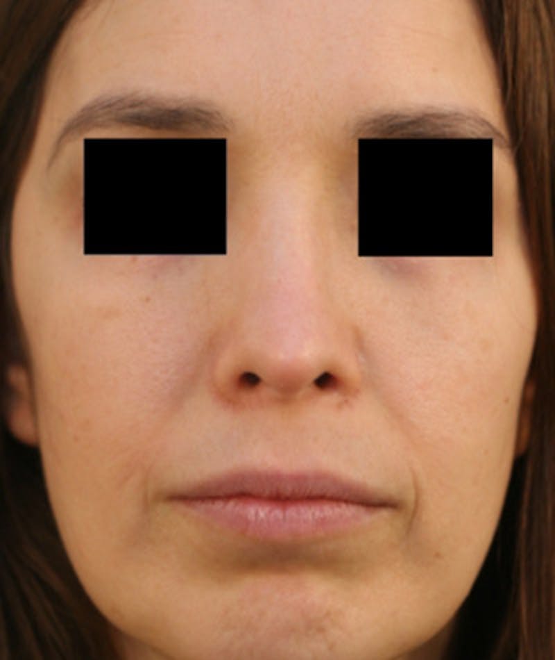 Ethnic Rhinoplasty Before & After Gallery - Patient 108189859 - Image 4