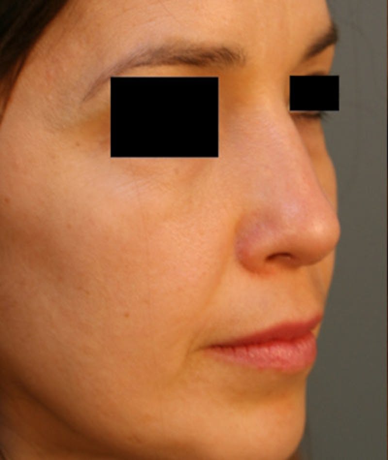Ethnic Rhinoplasty Before & After Gallery - Patient 108189859 - Image 5