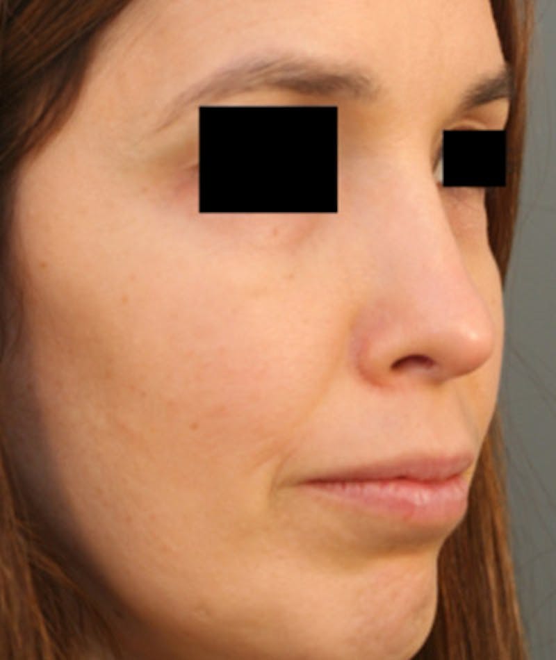 Ethnic Rhinoplasty Before & After Gallery - Patient 108189859 - Image 6