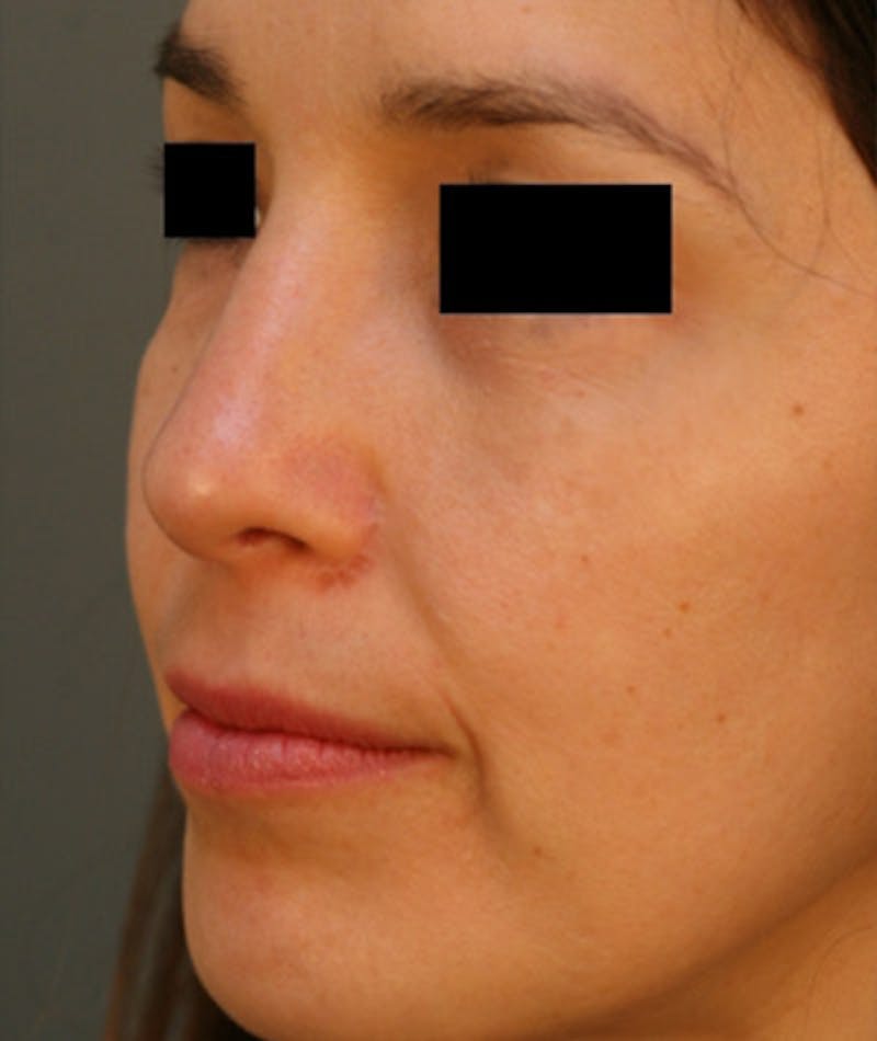 Ethnic Rhinoplasty Before & After Gallery - Patient 108189859 - Image 7