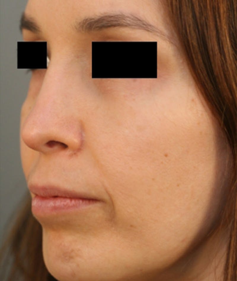 Ethnic Rhinoplasty Before & After Gallery - Patient 108189859 - Image 8